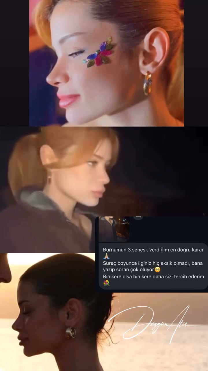 Rhinoplasty — 3 years later