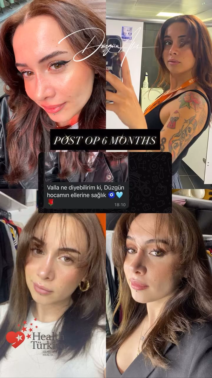 Rhinoplasty — 6 months post-op