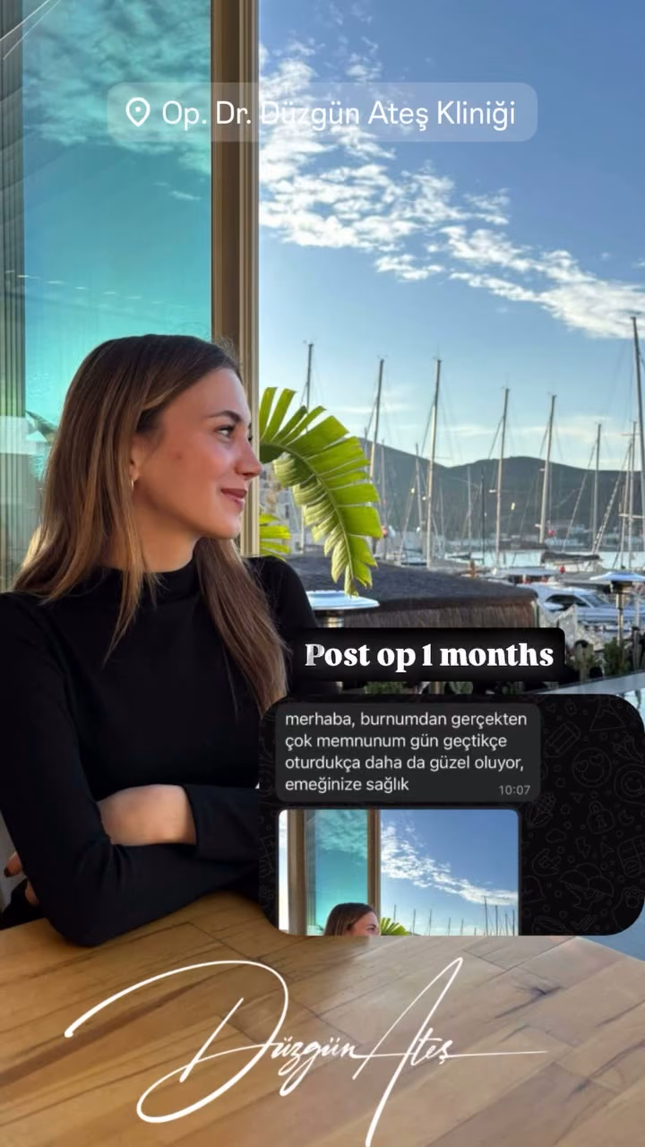 Rhinoplasty — 1 month post-op