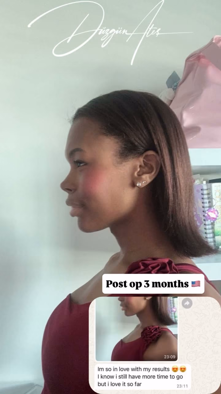 Rhinoplasty — 3 months post-op